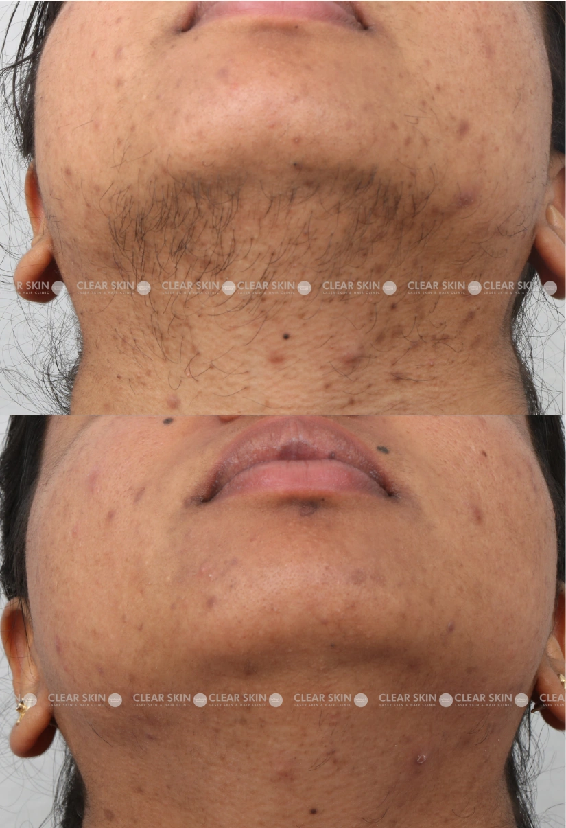 30yrs Female LHR Results 9 Months Timeline 9 Sessions ClearSkin Pune-3