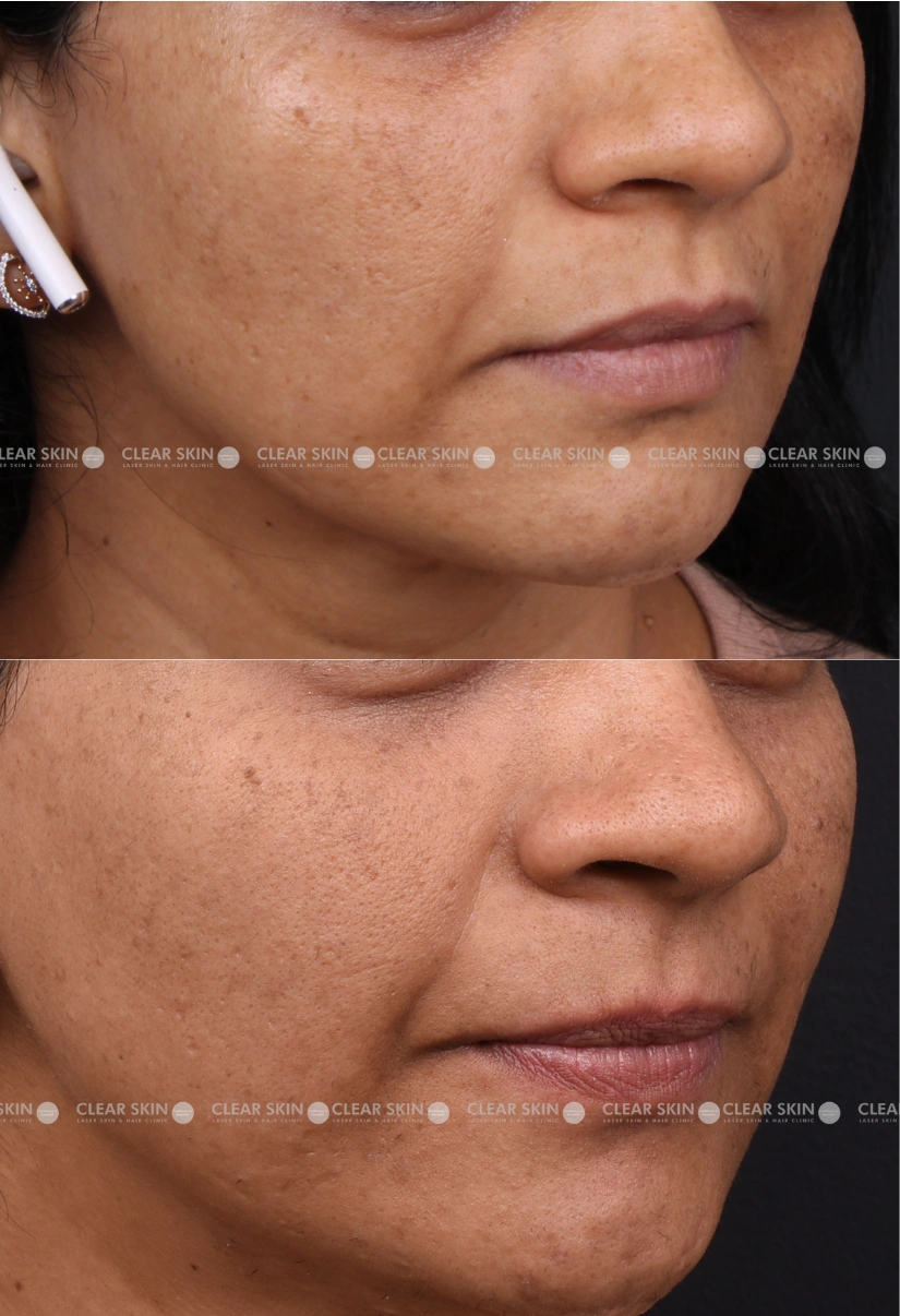 30yrs Female Skin Rejuvenation Results 6 Months Timeline 6 Sessions ClearSkin Pune 