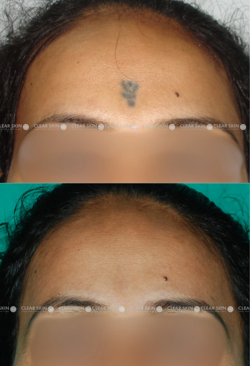 30yrs Female Tattoo Removal Results 3 Months Timeline 2 Sessions ClearSkin Pune (1)