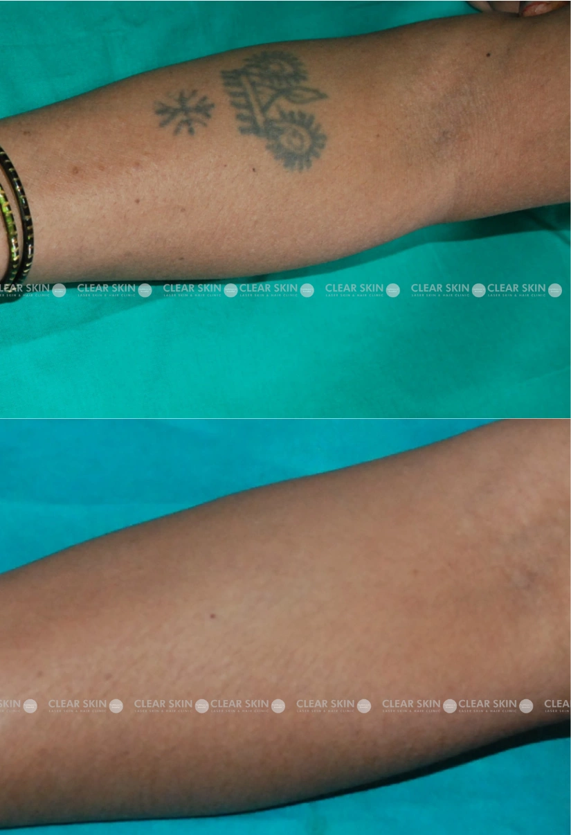 30yrs Female Tattoo Removal Results 3 Months Timeline 2 Sessions ClearSkin Pune (2)