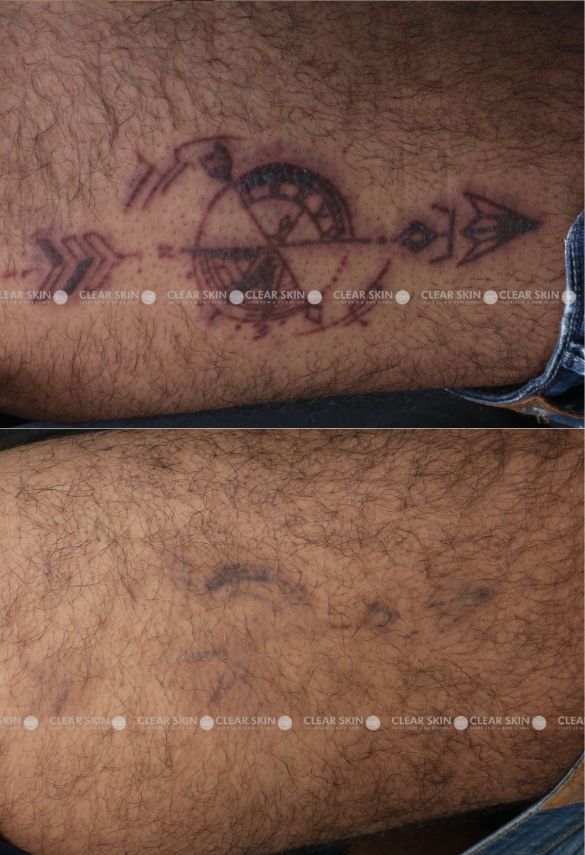 30yrs male Tattoo Removal Results 4 Months Timeline 4 Sessions ClearSkin Pune (2)