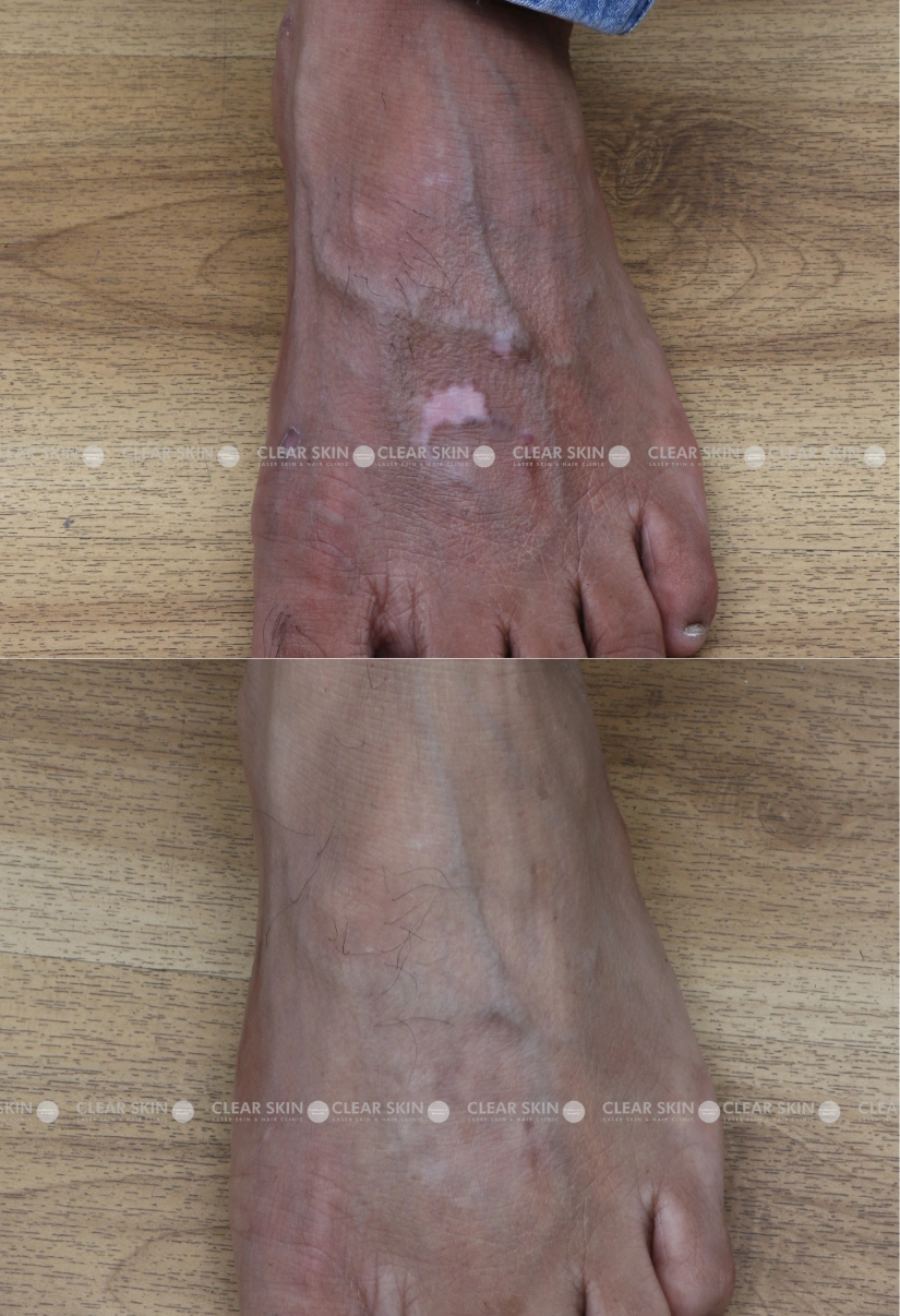 30yrs-male-Vitiligo-Results 5 Months Timeline 4 Sessions ClearSkin Pune