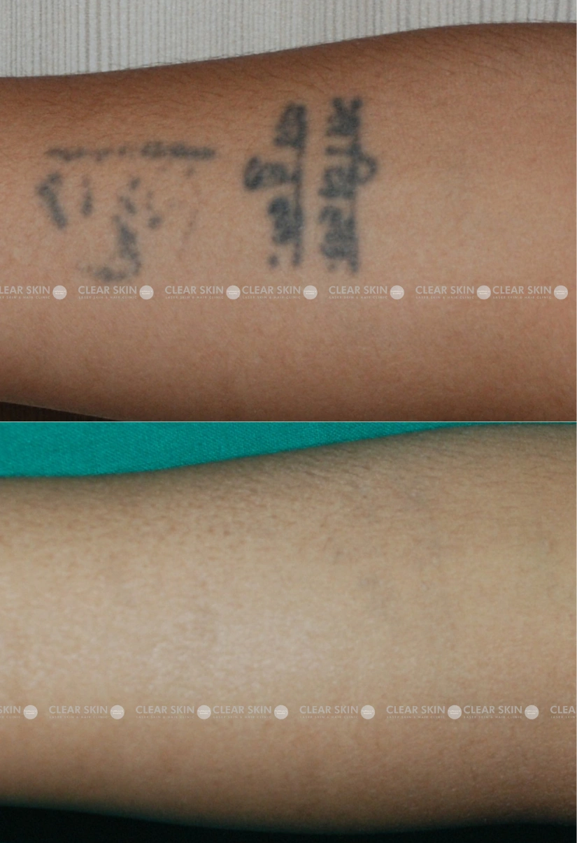 31yrs Female Tattoo Removal Results 3 Months Timeline 2 Sessions ClearSkin Pune