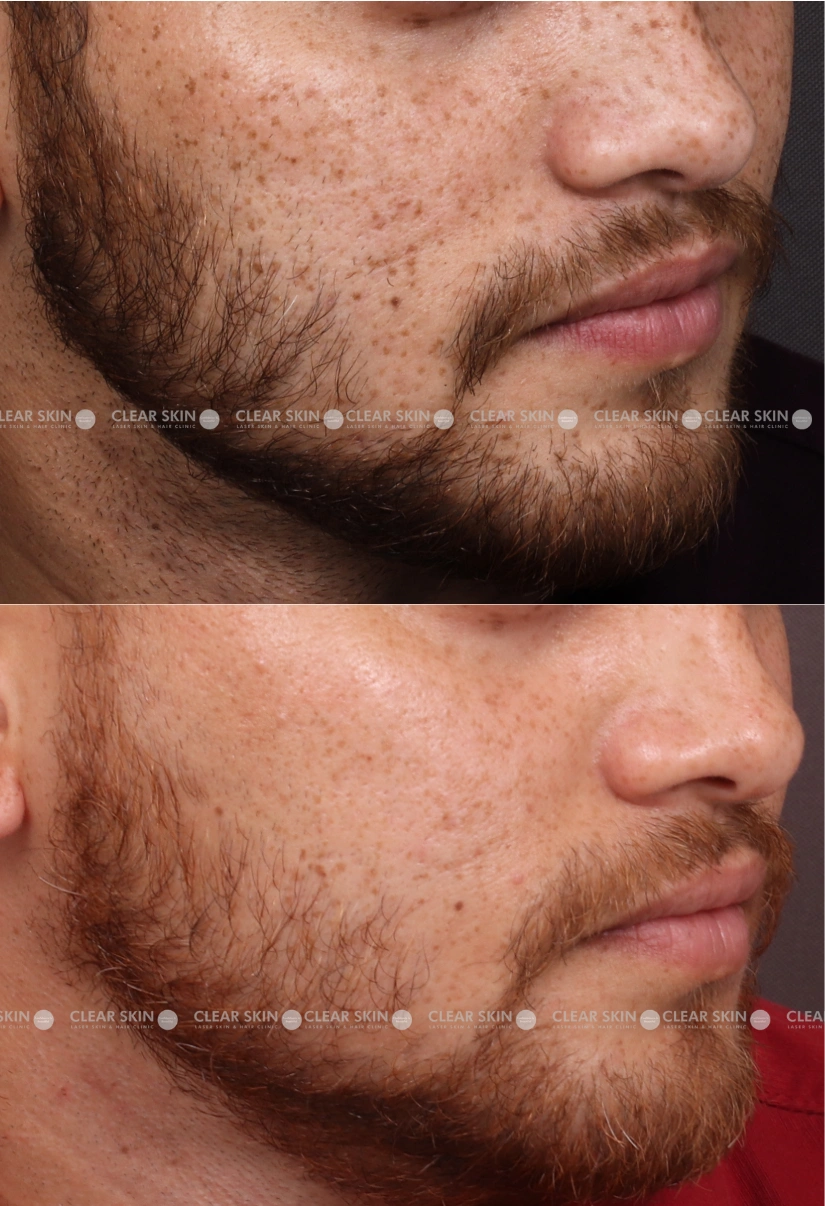 31yrs male Freckles Results 4 Months Timeline 4 Sessions ClearSkin  Pune