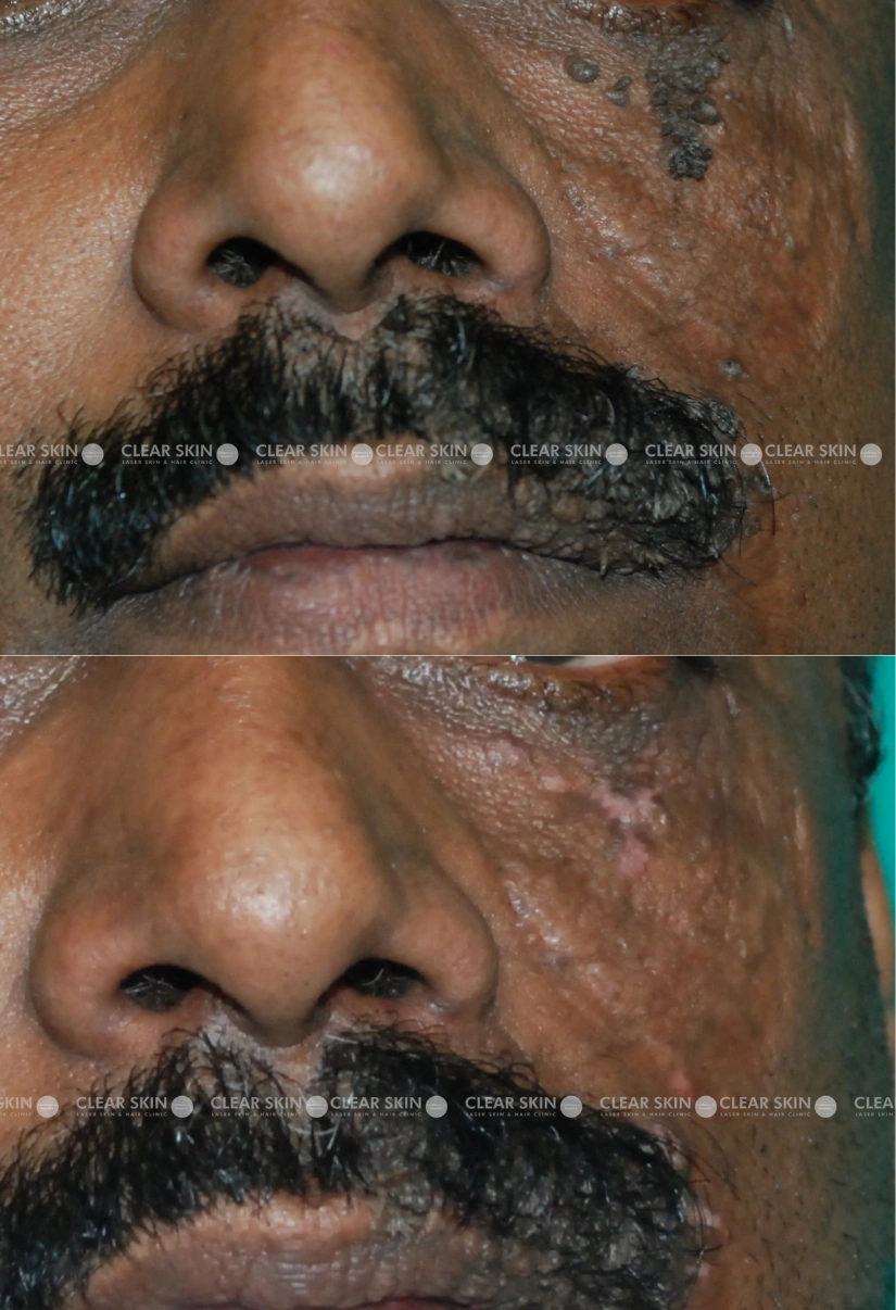 31yrs male Wart Removal Results 1 Months Timeline 1 Sessions ClearSkin Pune (2)