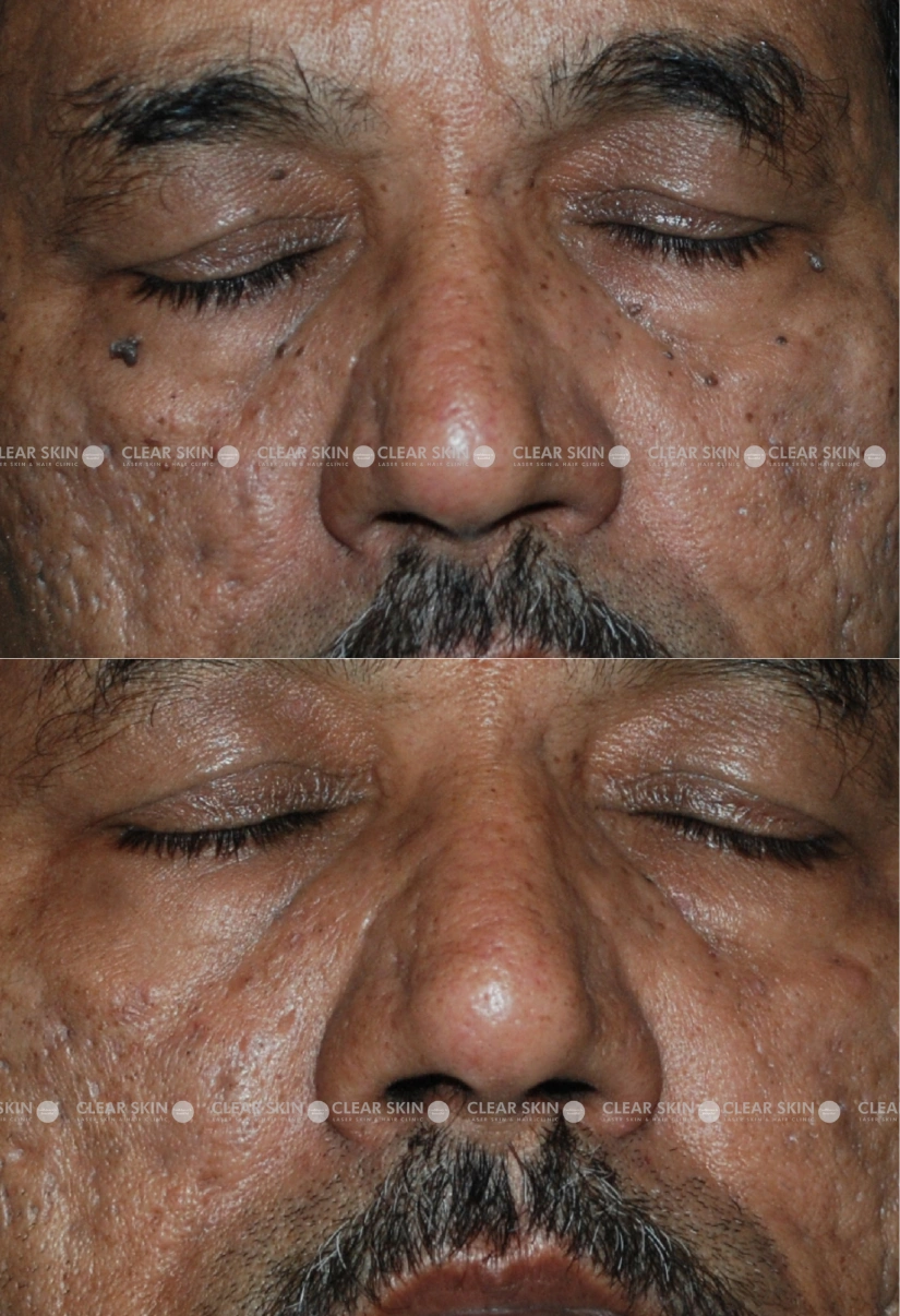 31yrs male Wart Removal Results 1 Months Timeline 1 Sessions ClearSkin Pune