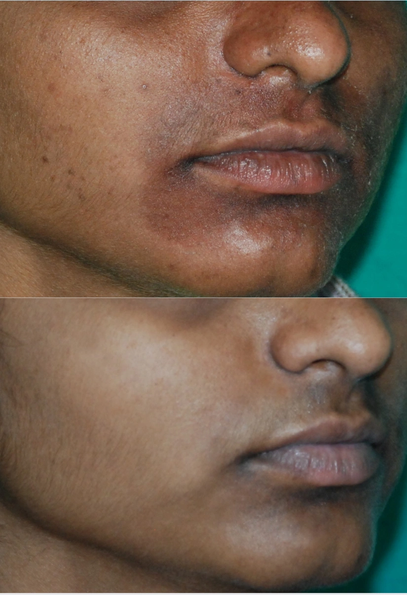 32yrs Female Pigmentation Results 6 Months Timeline 7 Sessions ClearSkin Pune