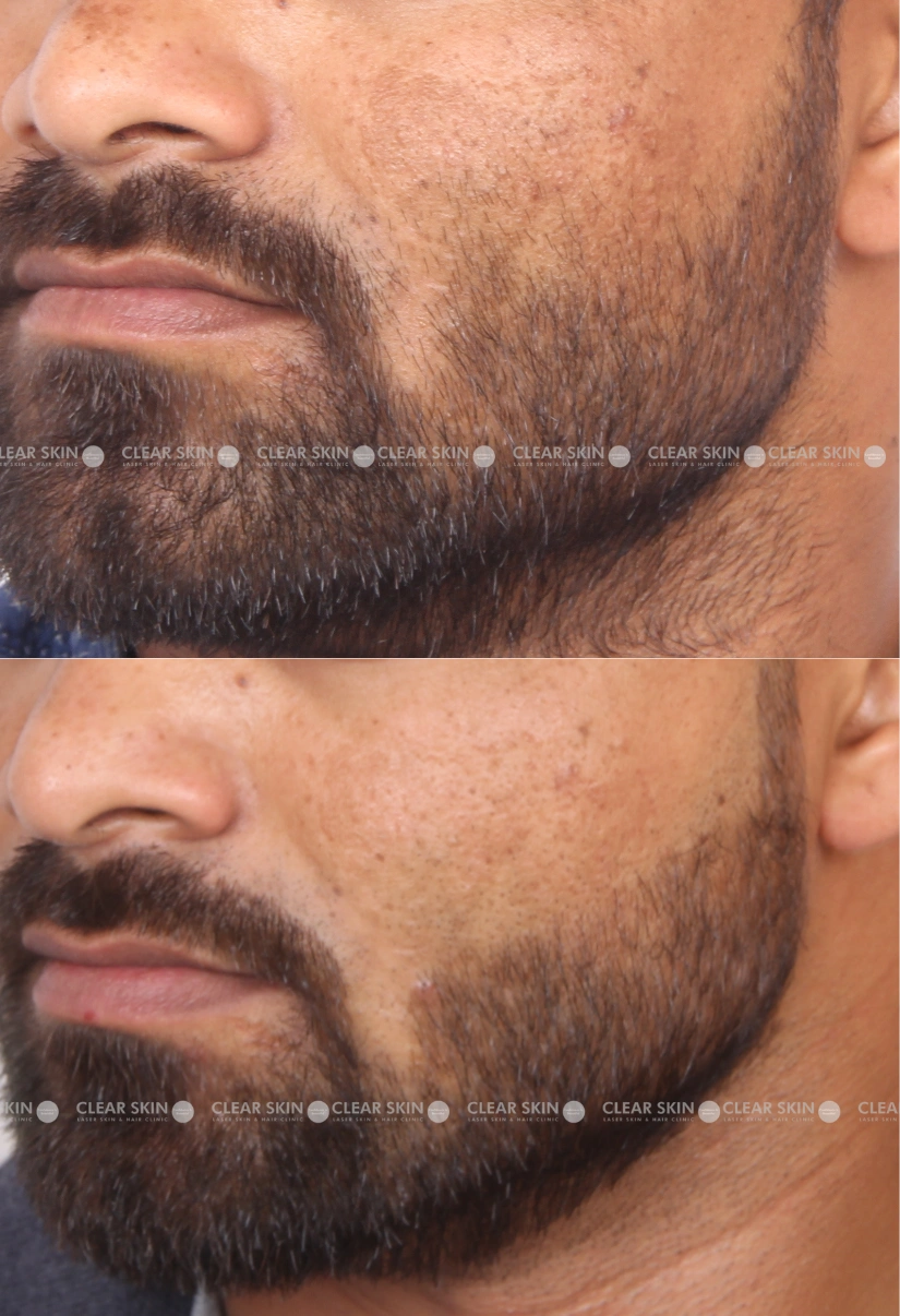 32yrs male Melasma Results 3 Months Timeline 4 Sessions ClearSkin Pune (2)