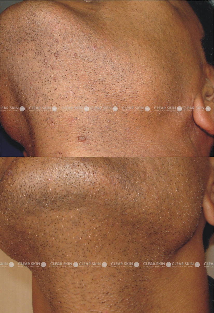 32yrs male Wart Removal Results 1 Months Timeline 1 Sessions ClearSkin Pune