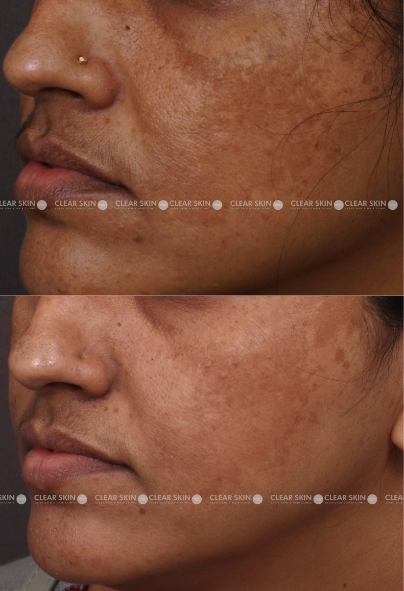 33yrs Female Melasma Results 8 Months Timeline 7 Sessions ClearSkin Pune (2)