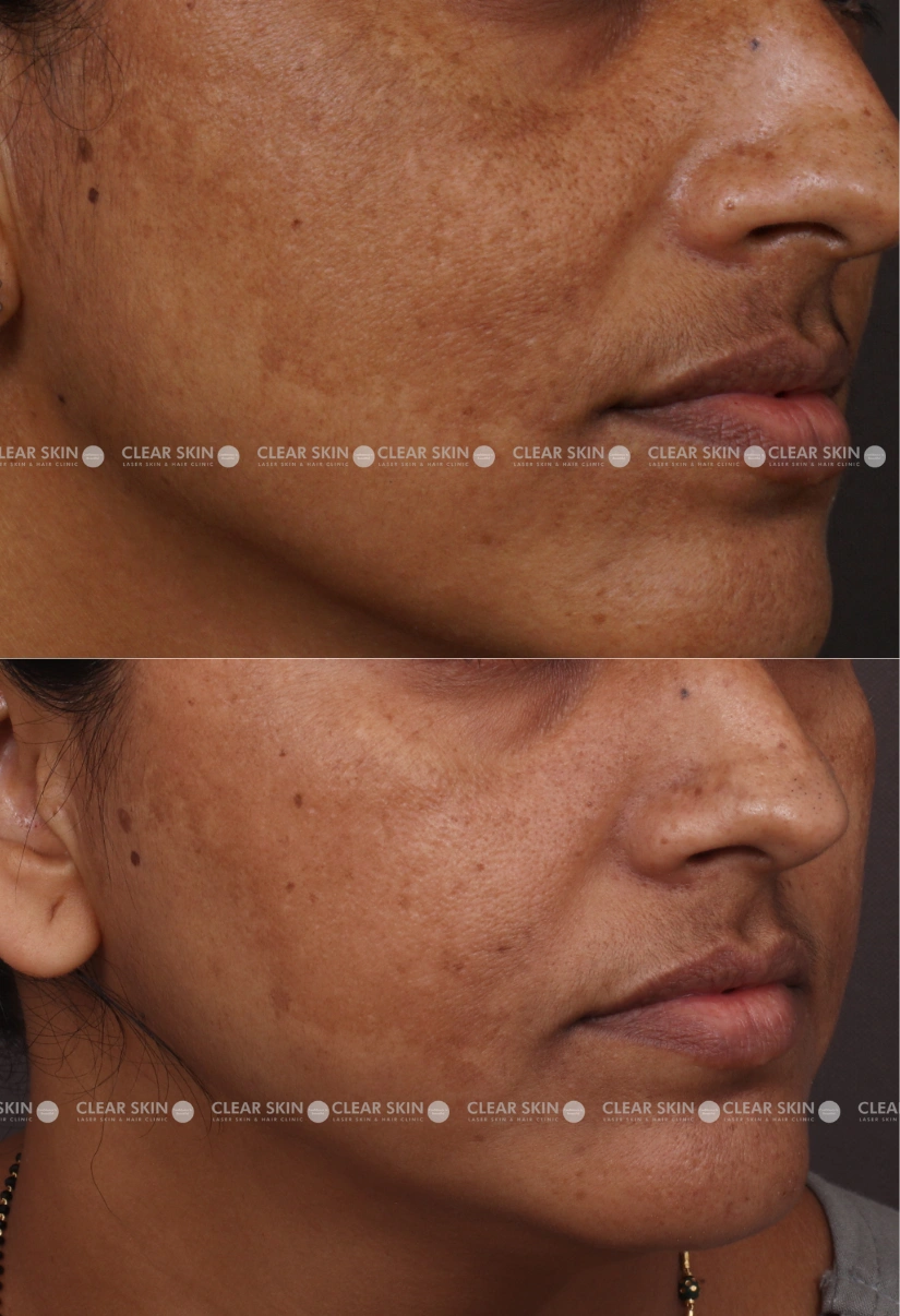 33yrs Female Melasma Results 8 Months Timeline 7 Sessions ClearSkin Pune