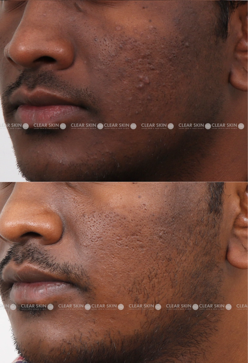 33yrs male Pigmentaion Results 3 Months Timeline 3 Sessions ClearSkin Pune (2)