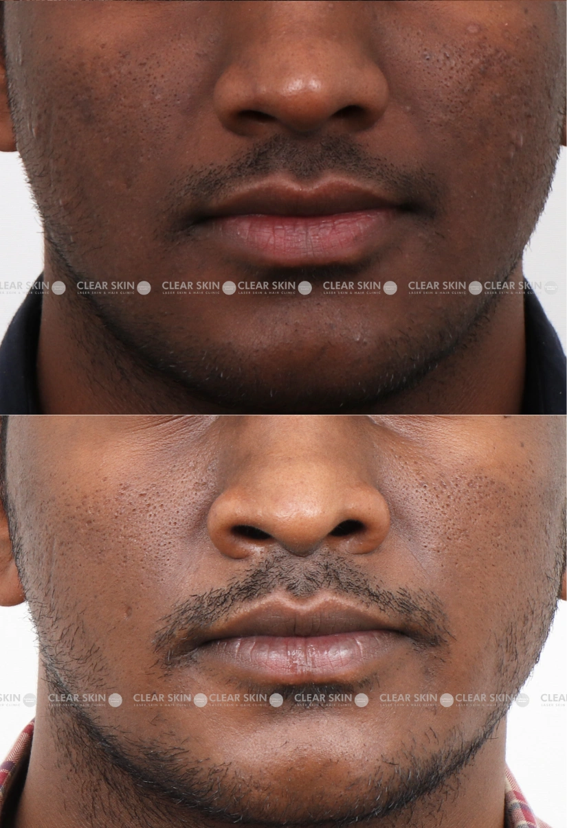 33yrs male Pigmentaion Results 3 Months Timeline 3 Sessions ClearSkin Pune