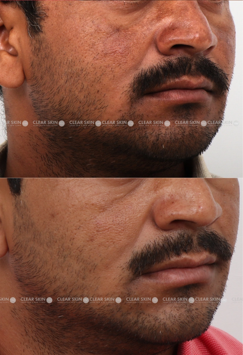 34yrs Female Melasma Results 3 Months Timeline 4 Sessions ClearSkin Pune (3)