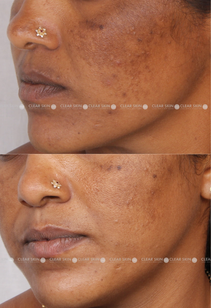 34yrs Female Melasma Results 5 Months Timeline 6 Sessions ClearSkin Pune (3)