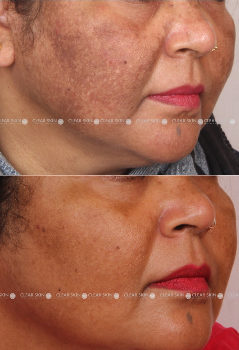 45yrs Female Melasma Results 9 Months Timeline 10 Sessions ClearSkin Pune (2)