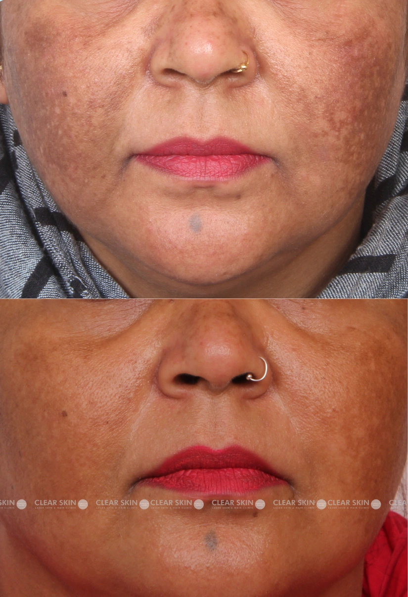 45yrs Female Melasma Results 9 Months Timeline 10 Sessions ClearSkin Pune