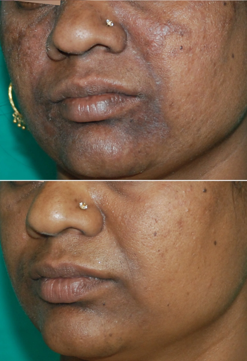 34yrs Female Pigmentation Results 6 Months Timeline 7 Sessions ClearSkin Pune