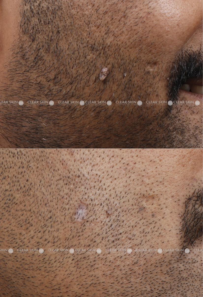 34yrs male Wart Removal Results 1 Months Timeline 2 Sessions ClearSkin Pune