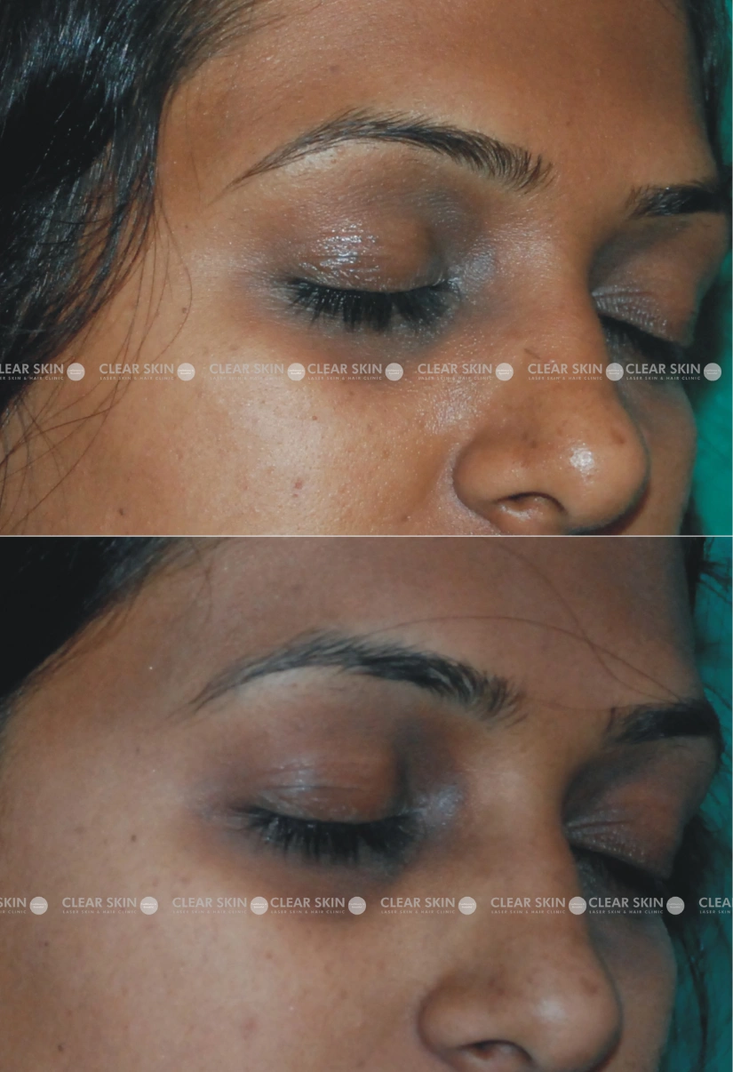 35yrs Female Darkcircles Results 5 Months Timeline 5 Sessions ClearSkin Pune (2)