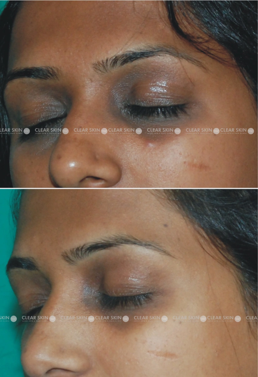 35yrs Female Darkcircles Results 5 Months Timeline 5 Sessions ClearSkin Pune (3)