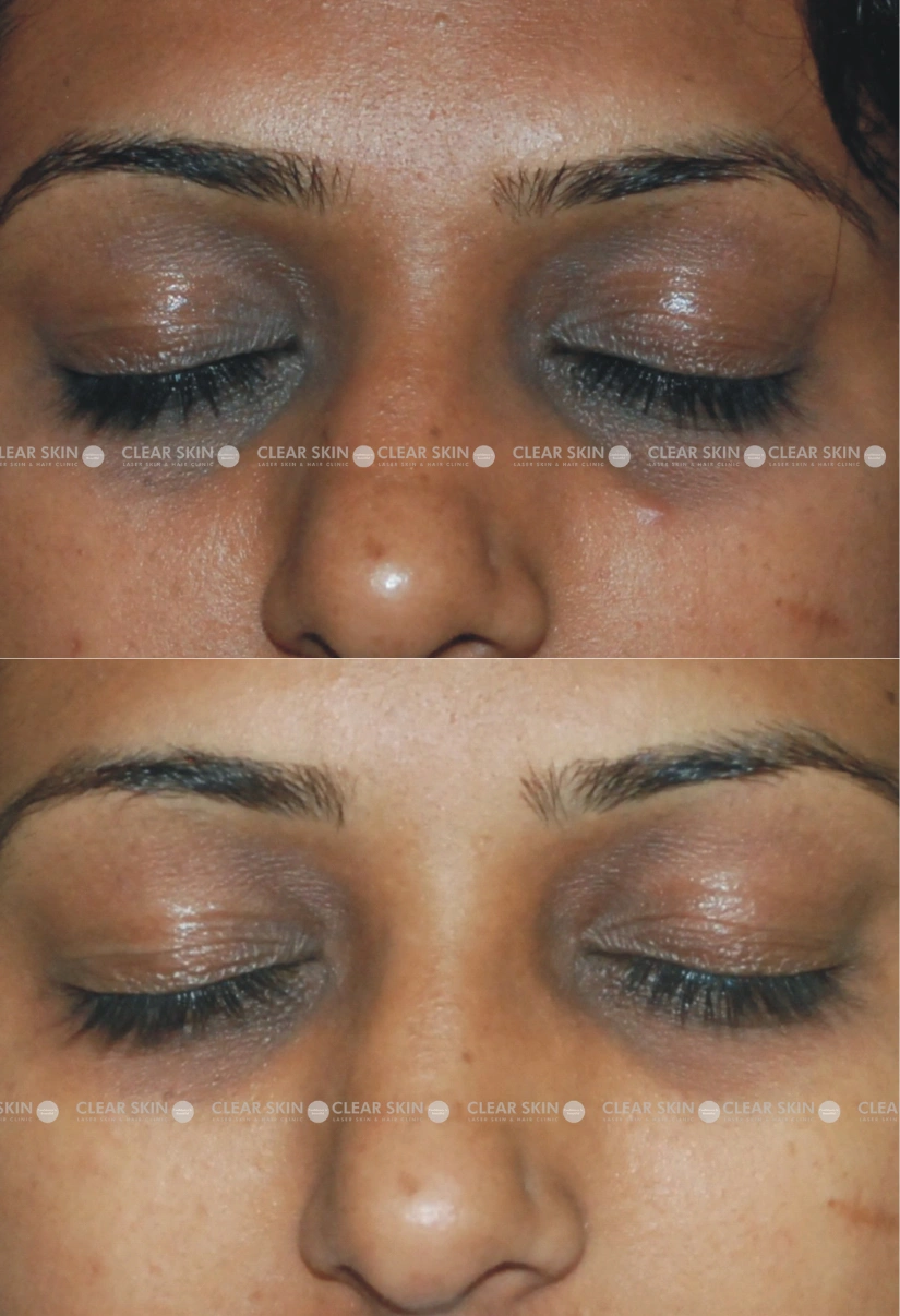 35yrs Female Darkcircles Results 5 Months Timeline 5 Sessions ClearSkin Pune