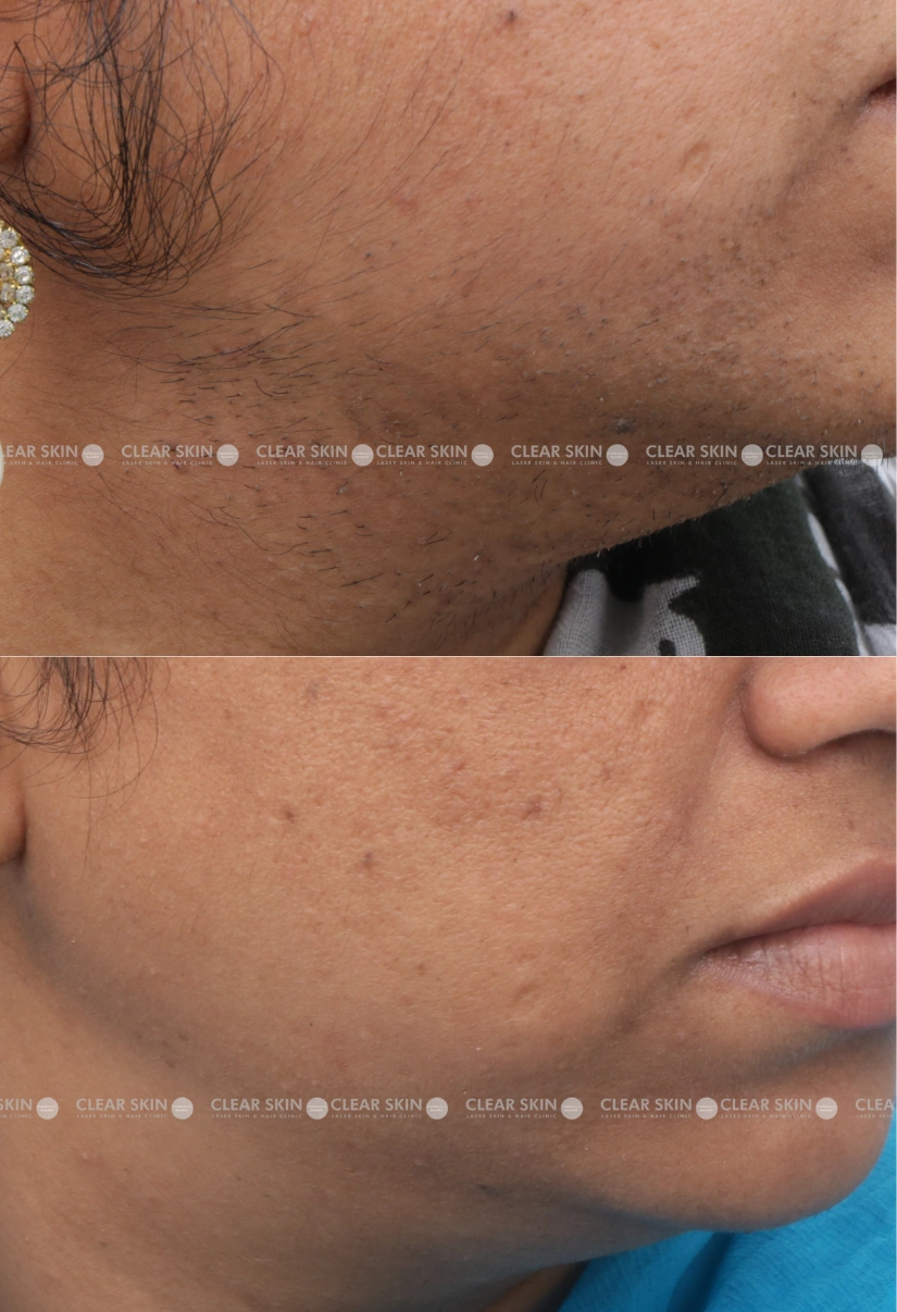 36yrs Female LHR Results 3 Months Timeline 3 Sessions ClearSkin Pune-3 (3)