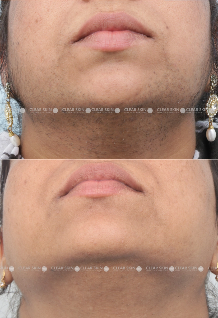 36yrs Female LHR Results 3 Months Timeline 3 Sessions ClearSkin Pune-3