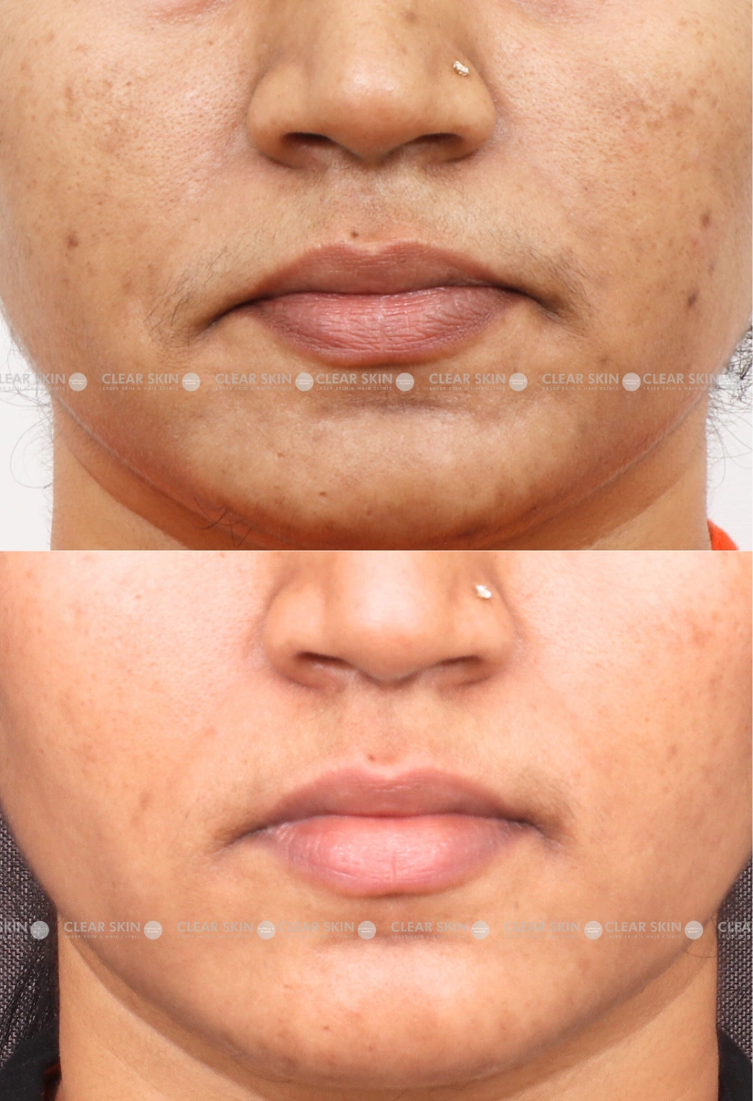 36yrs Female LHR Results 6 Months Timeline 5 Sessions ClearSkin Pune 1