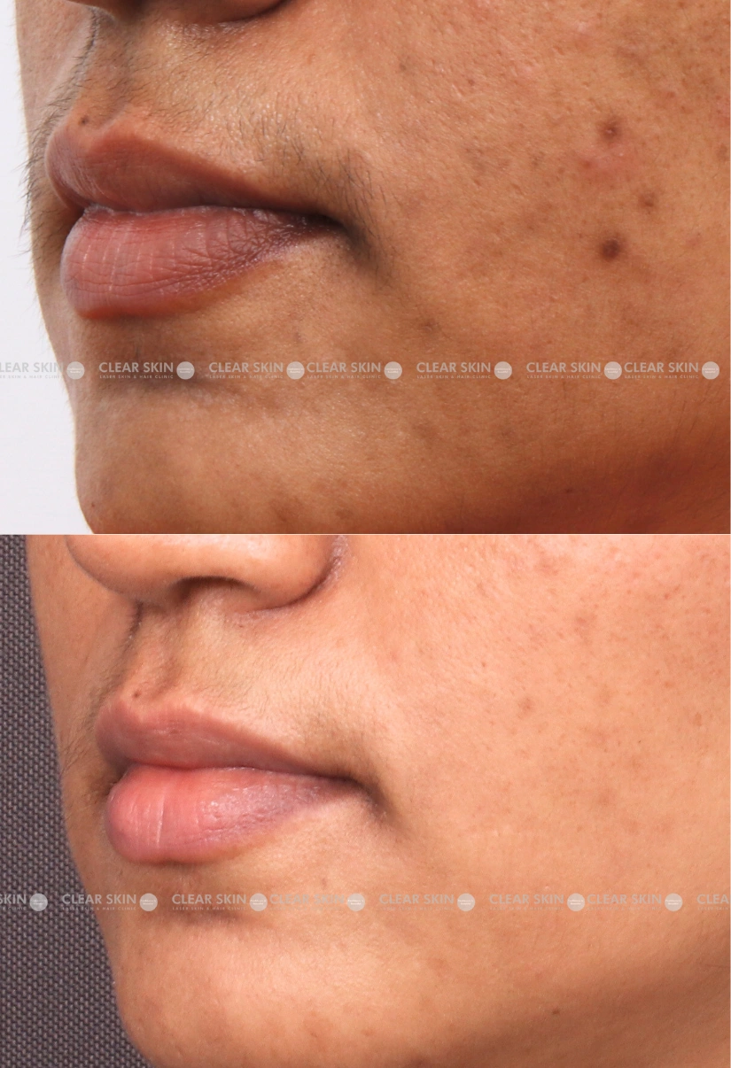 36yrs Female LHR Results 6 Months Timeline 5 Sessions ClearSkin Pune 2