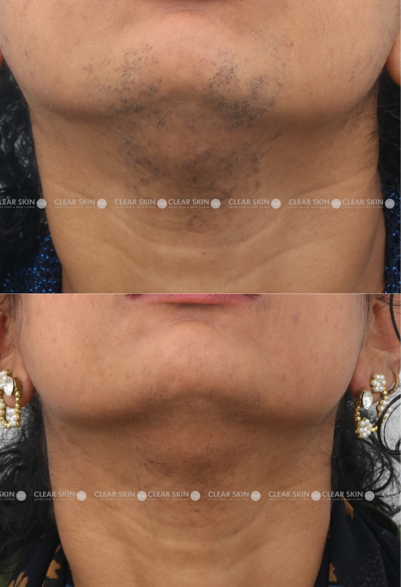 36yrs Female LHR Results 6 Months Timeline 5 Sessions ClearSkin Pune 3 (2)