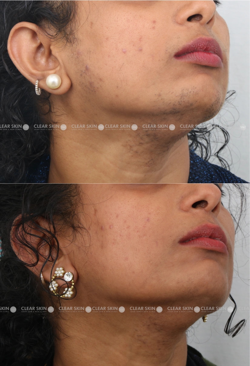 36yrs Female LHR Results 6 Months Timeline 5 Sessions ClearSkin Pune 3 (3)