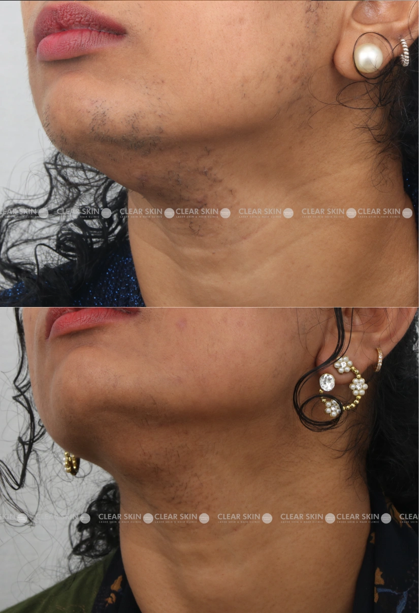 36yrs Female LHR Results 6 Months Timeline 5 Sessions ClearSkin Pune 3 (4)