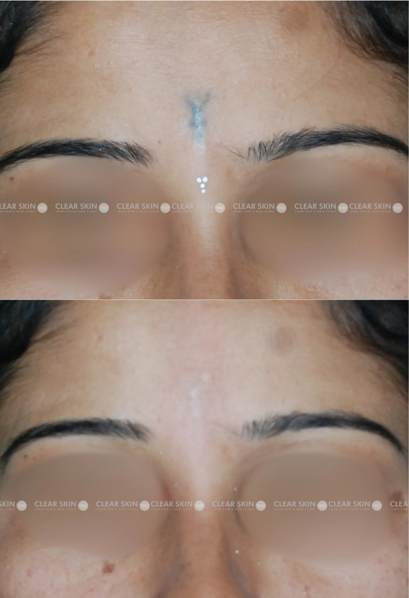 36yrs Female Tattoo Removal Results 3 Months Timeline 2 Sessions ClearSkin Pune