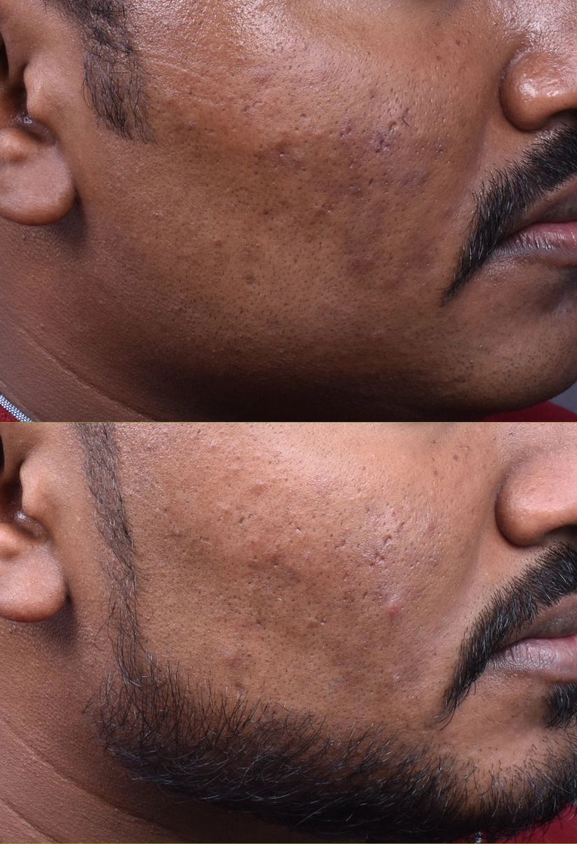 36yrs Pigmentation Results 3 Months Timeline 5 Sessions ClearSkin Pune