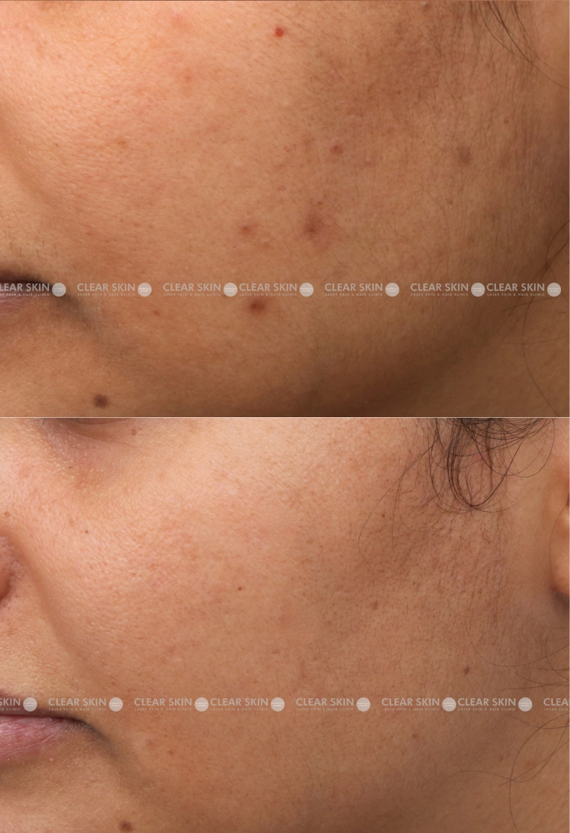 36yrs female DPN Results 3 Months Timeline 4 Sessions ClearSkin Pune