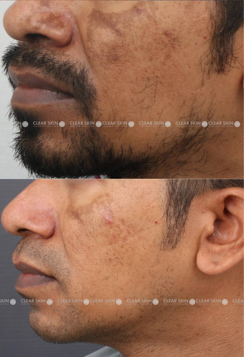 36yrs male Melasma Results 8 Months Timeline 9 Sessions ClearSkin Pune (2)