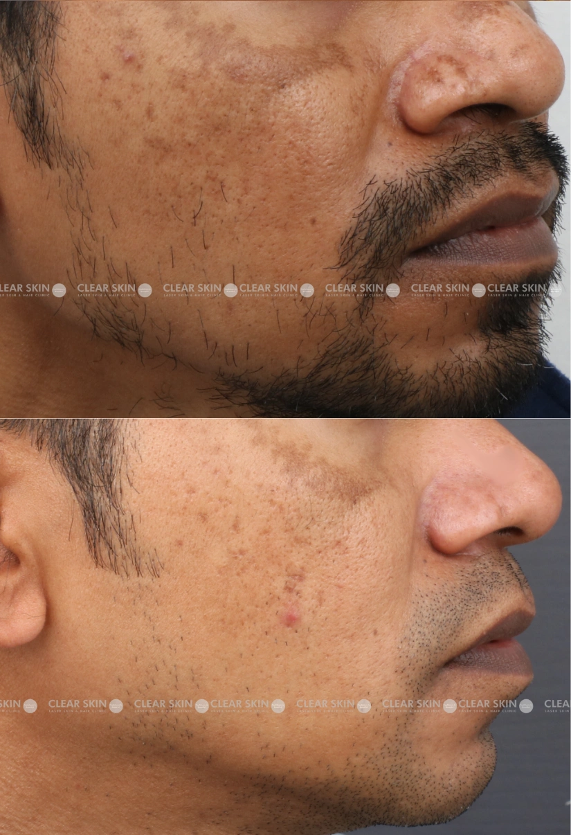 36yrs male Melasma Results 8 Months Timeline 9 Sessions ClearSkin Pune