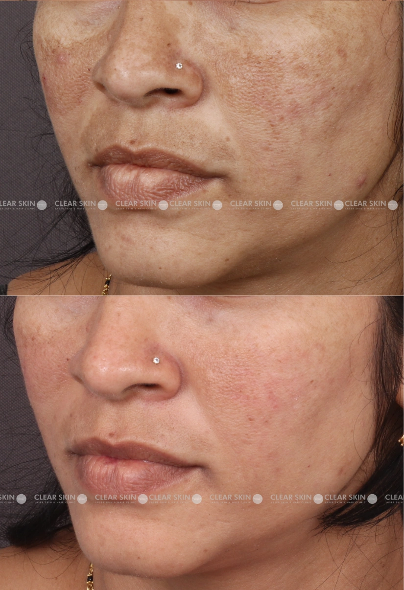 37yrs Female Melasma Results 2 Months Timeline 2 Sessions ClearSkin Pune (2)