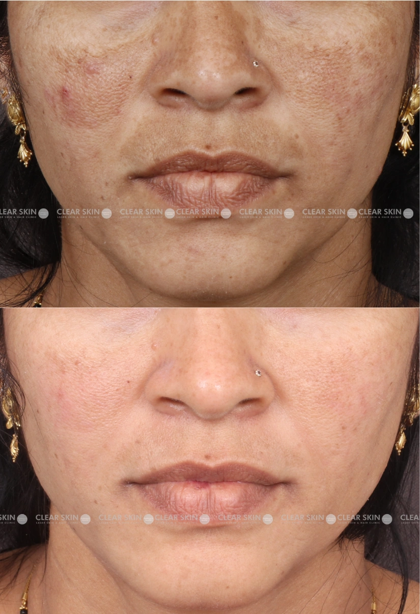 37yrs Female Melasma Results 2 Months Timeline 2 Sessions ClearSkin Pune