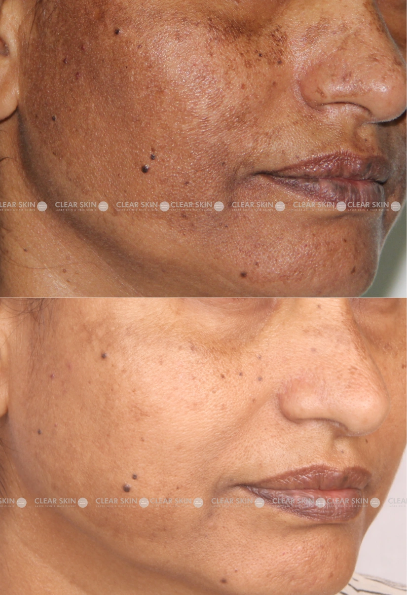 37yrs Female Melasma Results 6 Months Timeline 7 Sessions ClearSkin Pune (2)