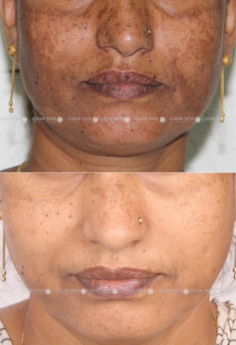 37yrs Female Melasma Results 6 Months Timeline 7 Sessions ClearSkin Pune