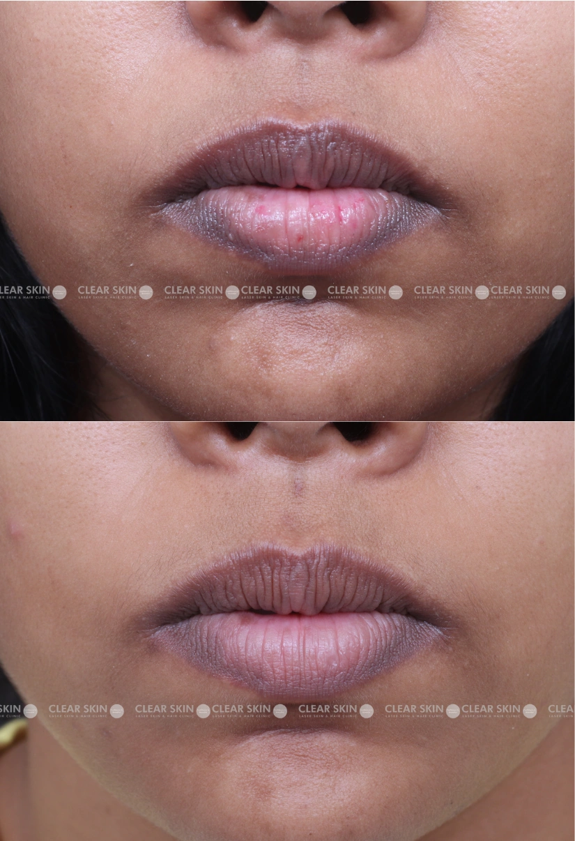 37yrs Female Pigmentation Results 4 Months Timeline 3 Sessions ClearSkin Pune