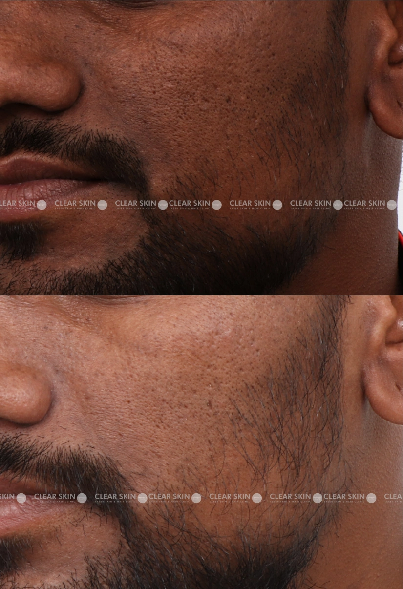 37yrs male Pigmentation Results 2 Months Timeline 3 Sessions ClearSkin Pune (3)