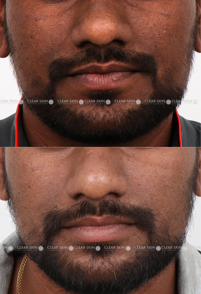 37yrs male Pigmentation Results 2 Months Timeline 3 Sessions ClearSkin Pune