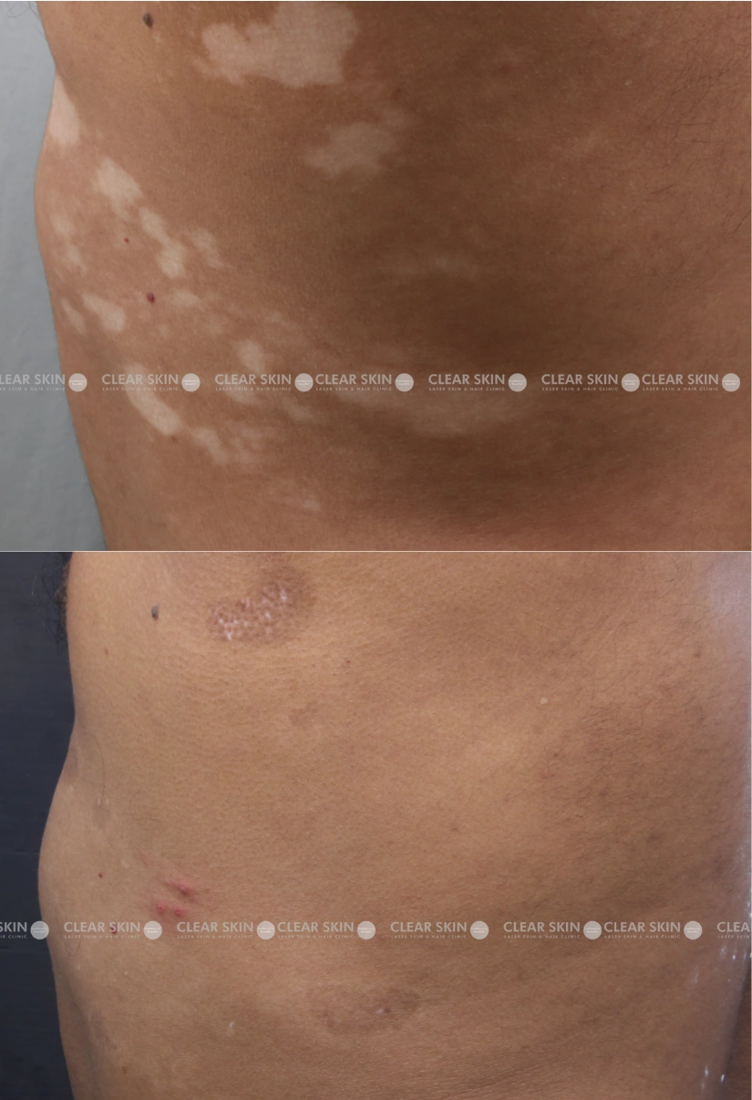 37yrs-male-Vitiligo-Results 5 Months Timeline 5 Sessions ClearSkin Pune