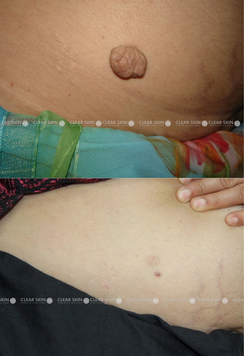 38yrs Female Wart Removal Results 1 Months Timeline 1 Sessions ClearSkin Pune