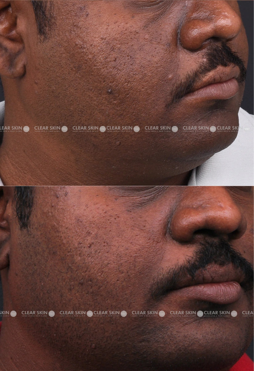 39yrs male Pigmentation Results 2 Months Timeline 2 Sessions ClearSkin Pune