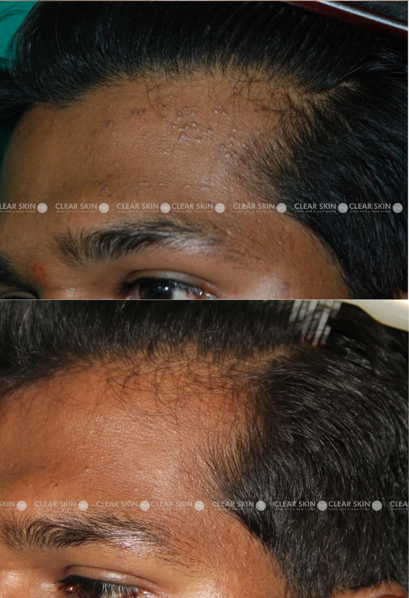 39yrs male Wart Removal Results 1 Months Timeline 1 Sessions ClearSkin Pune