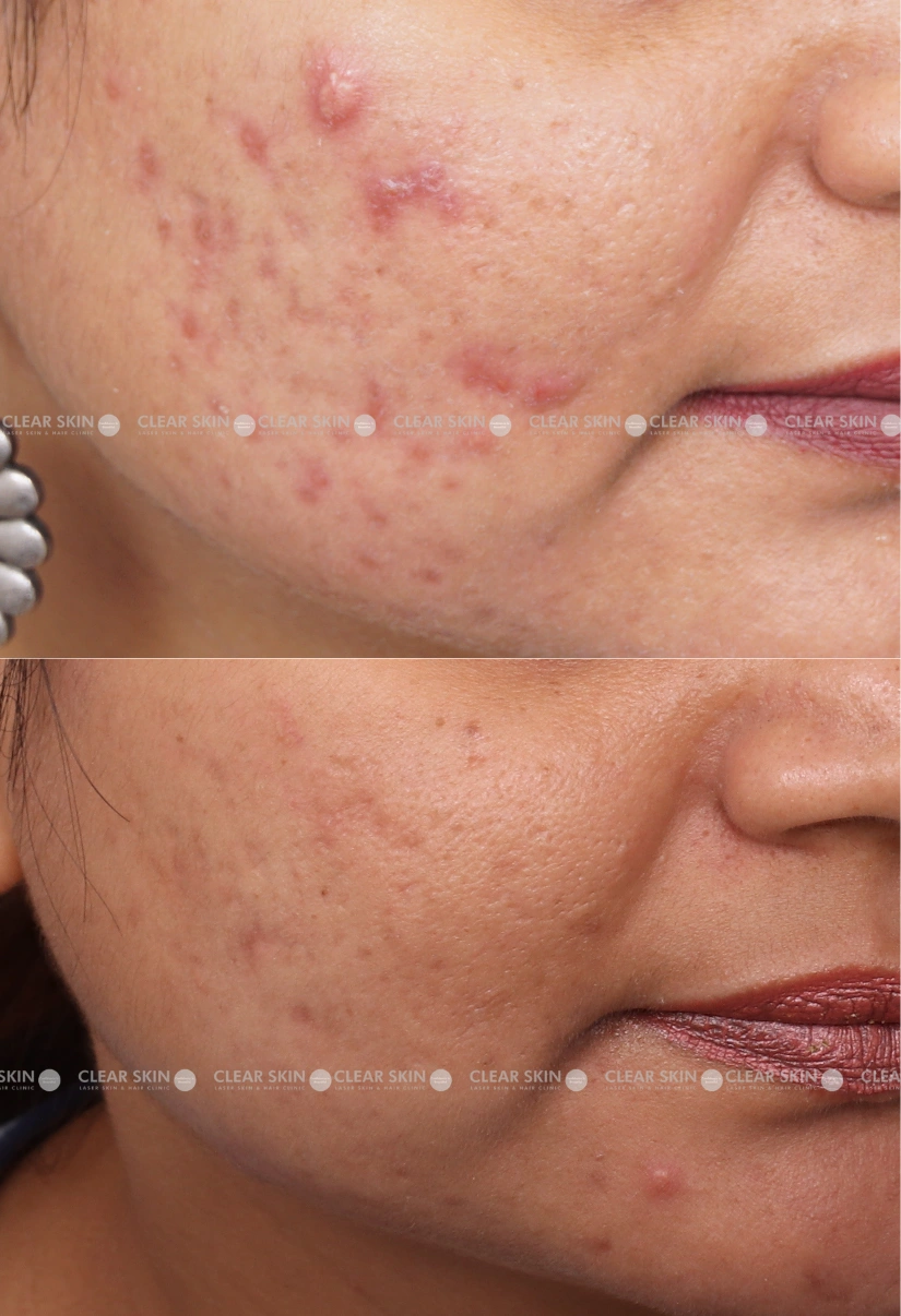 40yrs Female Acne Results 6 Months Timeline 7 Sessions ClearSkin Pune (2)